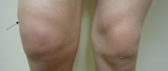 Колено опухло