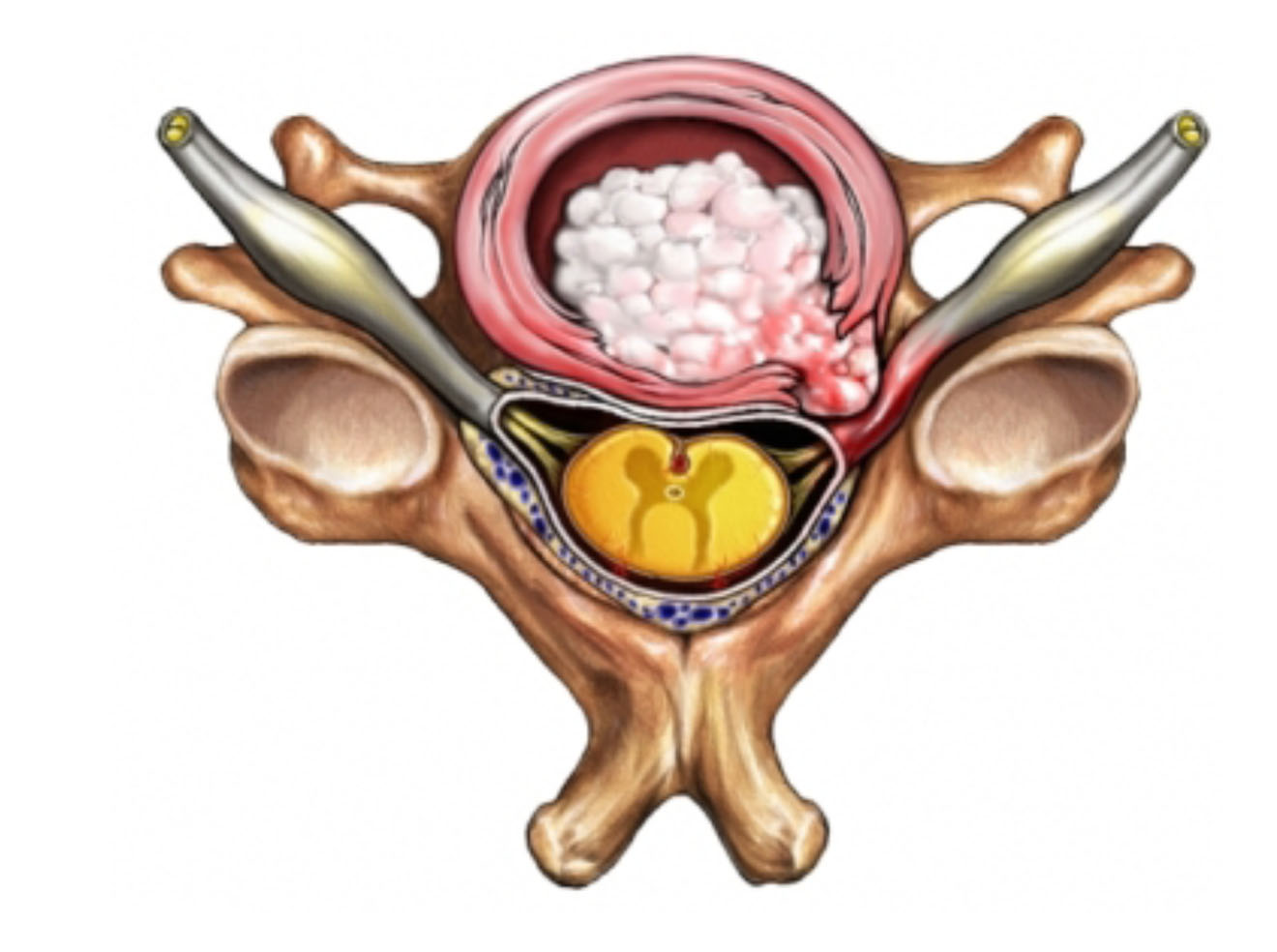 Корешковый синдром поясничного отдела: симптомы и лечение позвоночника