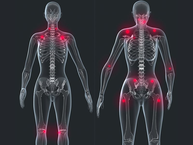 Фибромиалгия: симптомы, лечение, диагностика